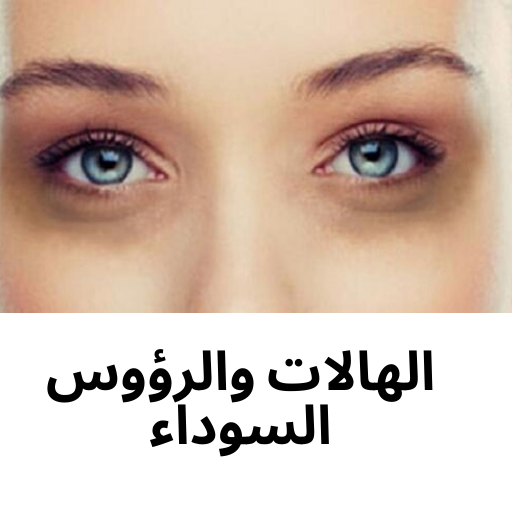 أسباب الهالات السوداء