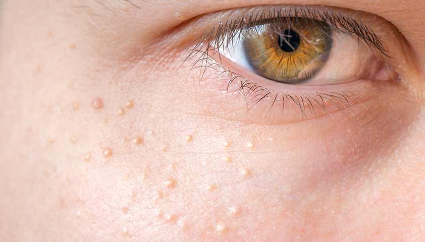 وصفات للبثور البيضاء