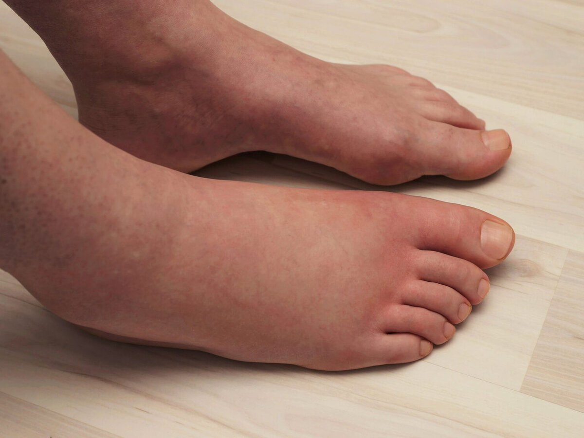 تورم القدمين