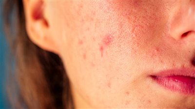 قناع طبيعي يخلصك من حب الشباب فى الصيف