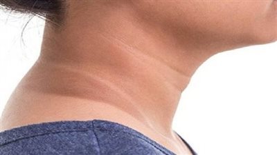 أعراض مقاومة الأنسولين