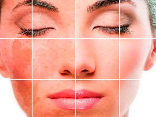 أسباب تصبغات الوجه