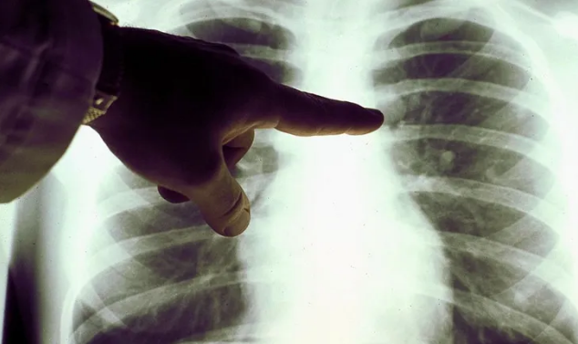 الإصابة بسرطان الرئة،فيتو