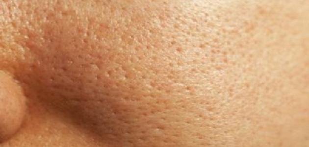 قناع طبيعي يخلصك من البثور البيضاء 