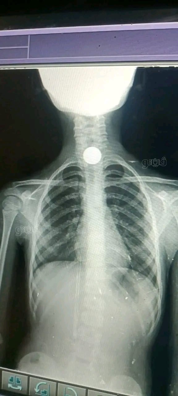 بمنظار الطوارئ.. إنقاذ طفلة بالشرقية من موت محقق بعد ابتلاع عملة معدنية،فيتو