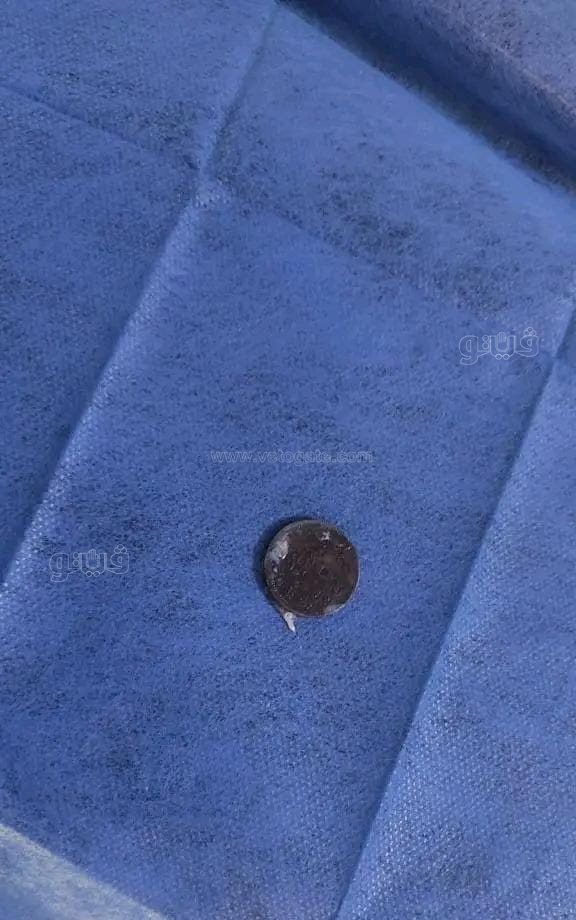 بمنظار الطوارئ.. إنقاذ طفلة بالشرقية من موت محقق بعد ابتلاع عملة معدنية،فيتو