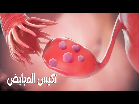 أسباب تكيسات المبايض