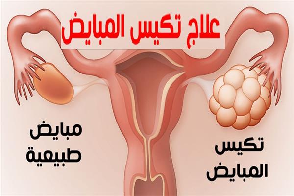 علاج تكيسات المبايض