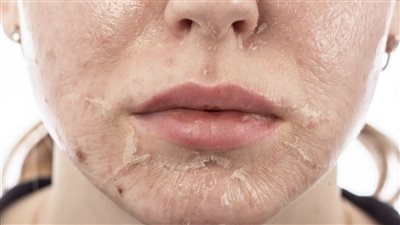 قناع طبيعي يقضى على الندبات بالبشرة 