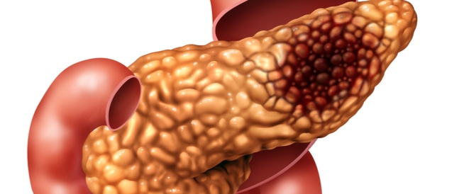 ارتفاع انزيمات البنكرياس 