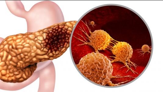 سرطان البنكرياس