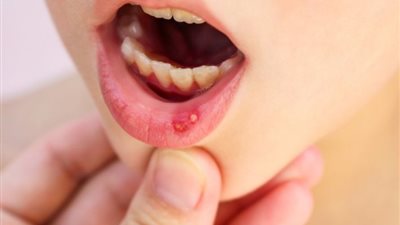 أسباب الهربس عند الأطفال