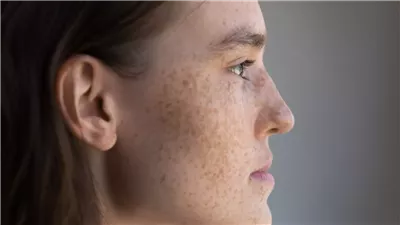 خطوات بسيطة تخلصك من البقع الداكنة بالبشرة