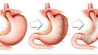 خطورة عمليات تكميم المعدة على الأطفال