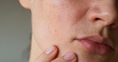 نصائح بسيطة تساعدك فى تجنب ظهور الندبات بالبشرة