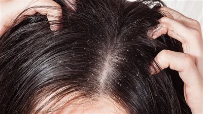 طرق التخلص من قشرة الشعر 