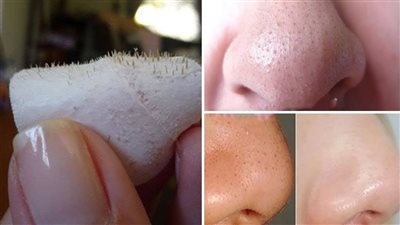 طرق بسيطة تخلصك من البثور البيضاء بالبشرة 