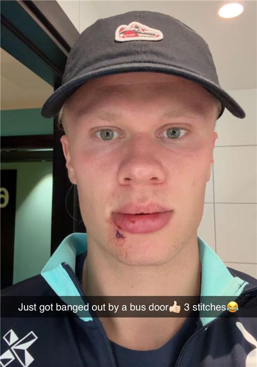 هالاند يتعرض لحادث قبل مواجهة مولدوفا بتصفيات كأس العالم