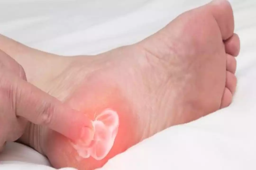 أعراض مسمار الكعب&nbsp;