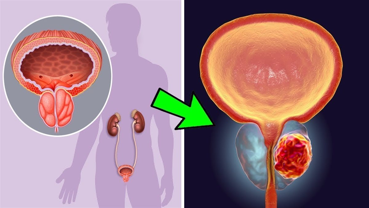 اعراض تضخم البروستاتا
