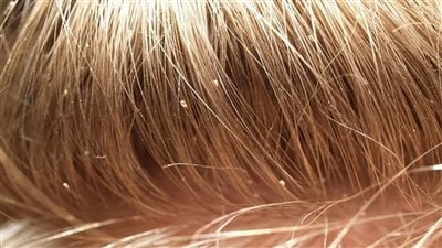 علاج قمل الشعر 