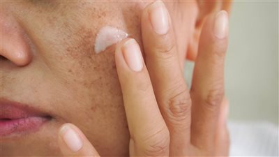 طرق علاج النمش بالبشرة 