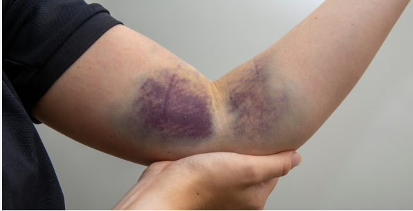 تلف الأوعية الدموية، فيتو