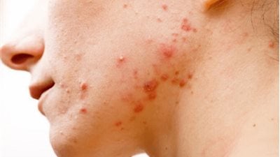 نصائح تجنبك ظهور حب الشباب بالبشرة