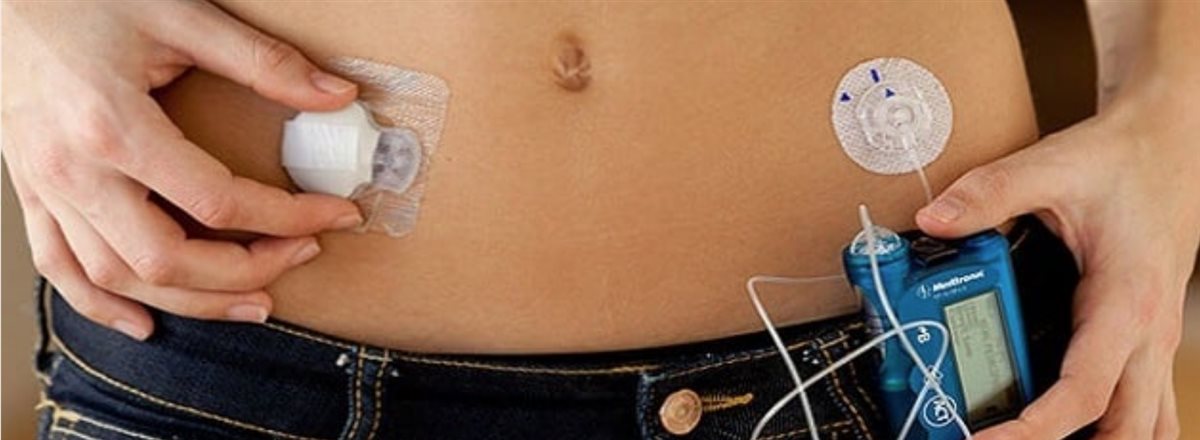 البنكرياس الصناعي الجديد أمل لمرضى السكر، فيتو