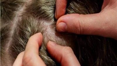 إجراءات وقائية تجنب طفلك عدوى القمل فى المدارس 