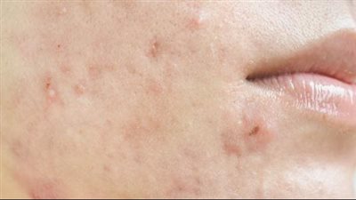 خطوات بسيطة للتخلص من الندبات والبقع