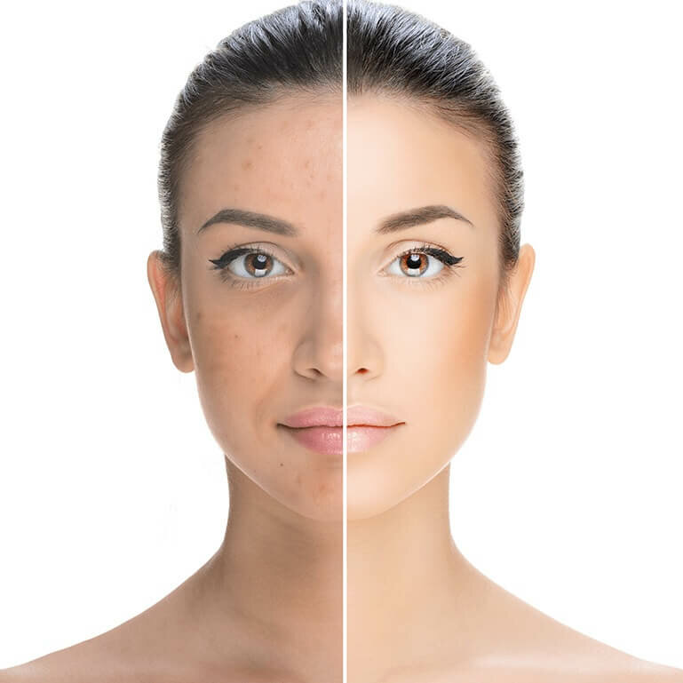 تفتيح البشرة