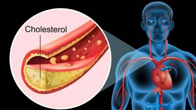 الدهون الثلاثية بالدم 