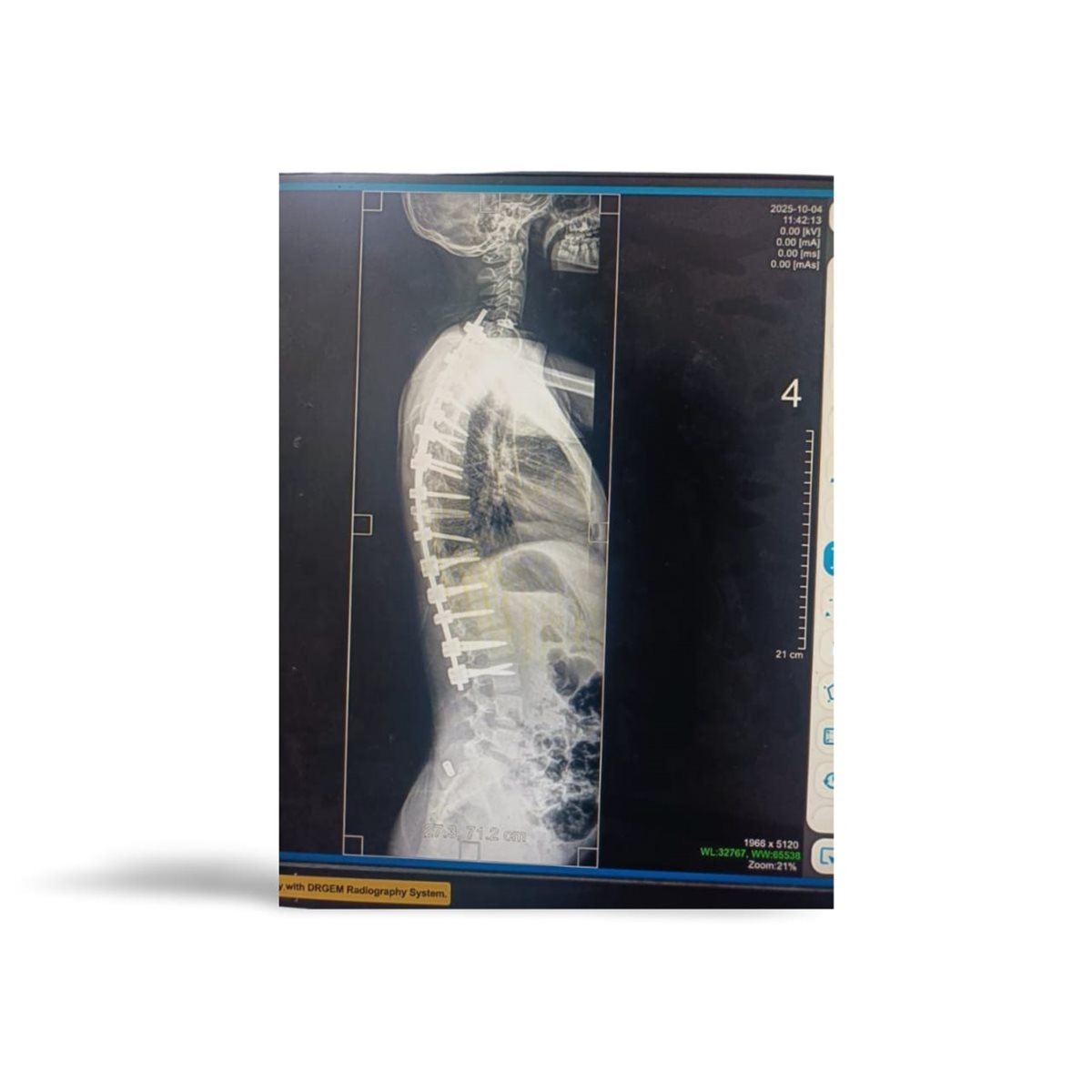 صور الأشعة بعد الجراحة، فيتو