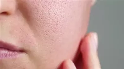 المسام الواسعة بالبشرة 