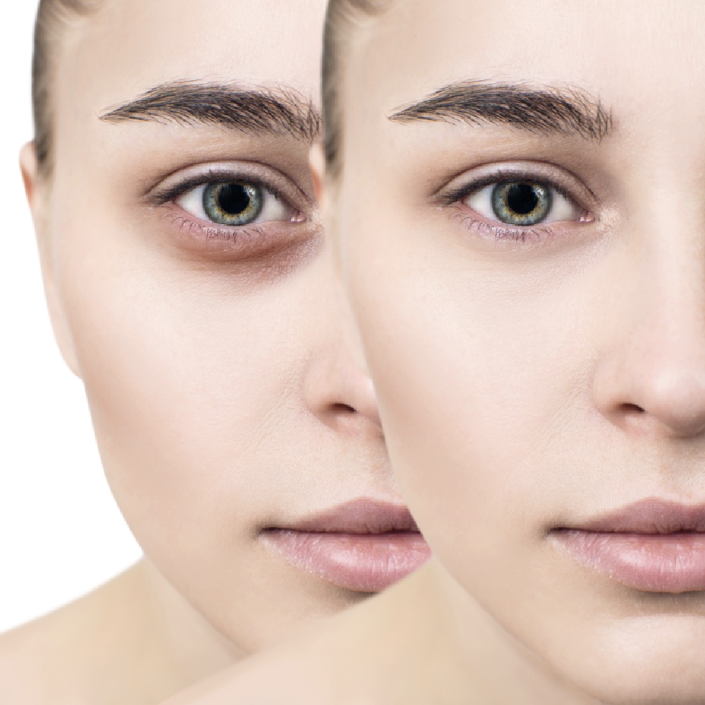 علاج الهالات السوداء