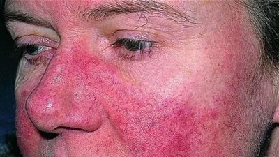 الذئبة الحمراء 