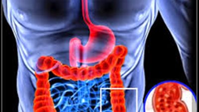 التهابات القولون 