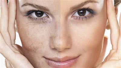 تقشير البشرة&nbsp;