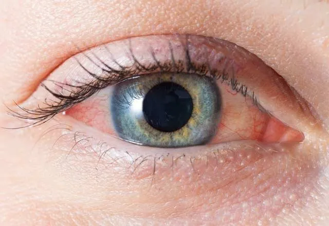 مرض التراكوما