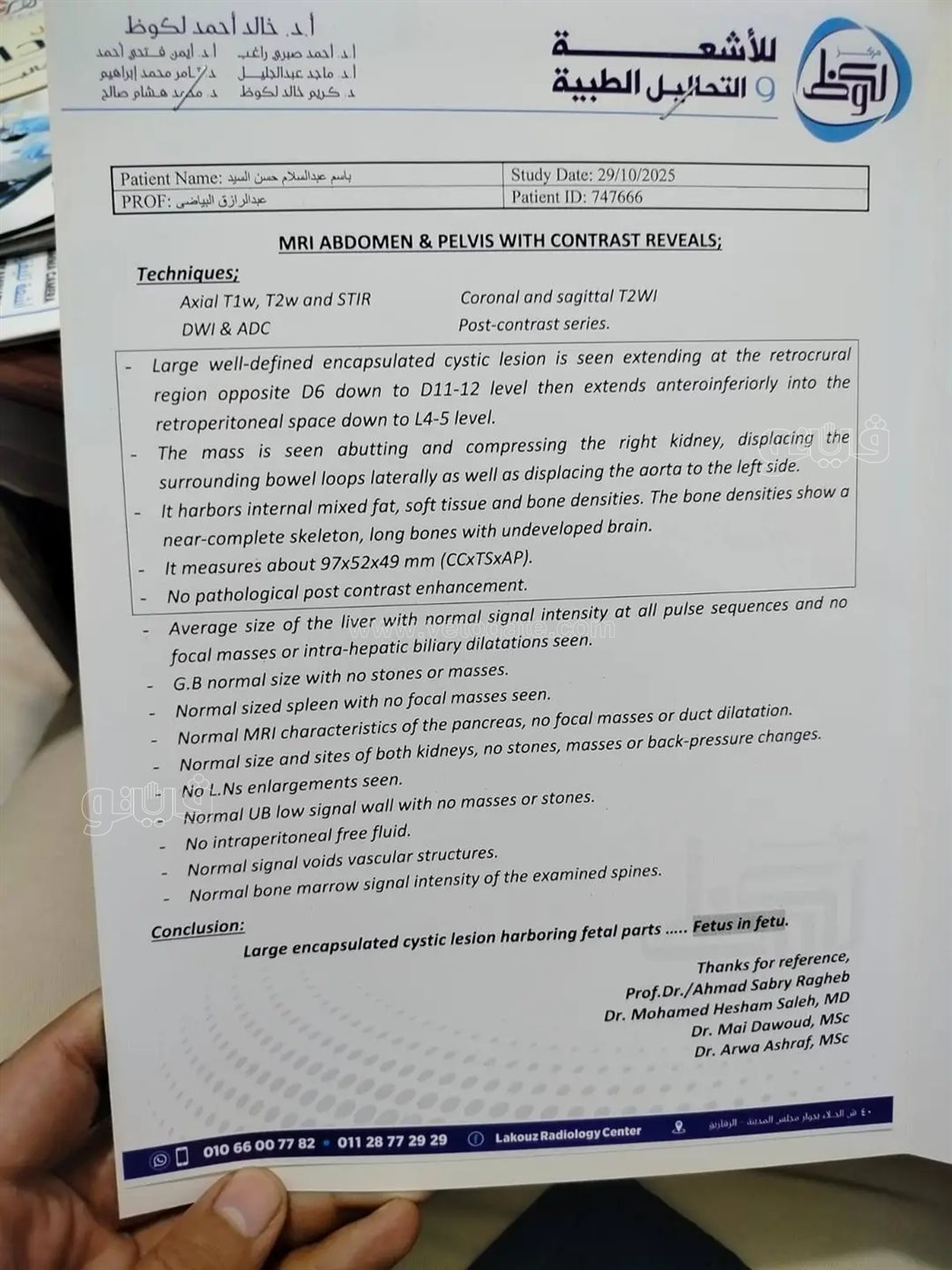 حين نما التوأم في صدر شقيقه… وسُطرت واحدة من أجمل قصص الطب والرحمة،فيتو