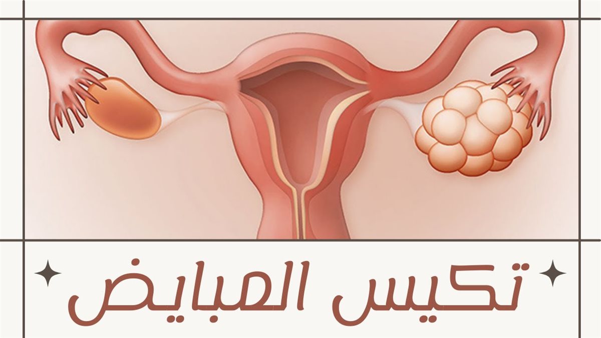 تكيس المبيض