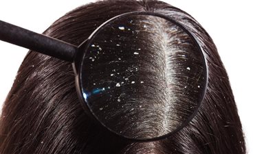 نصائح تحمى من قشرة الشعر