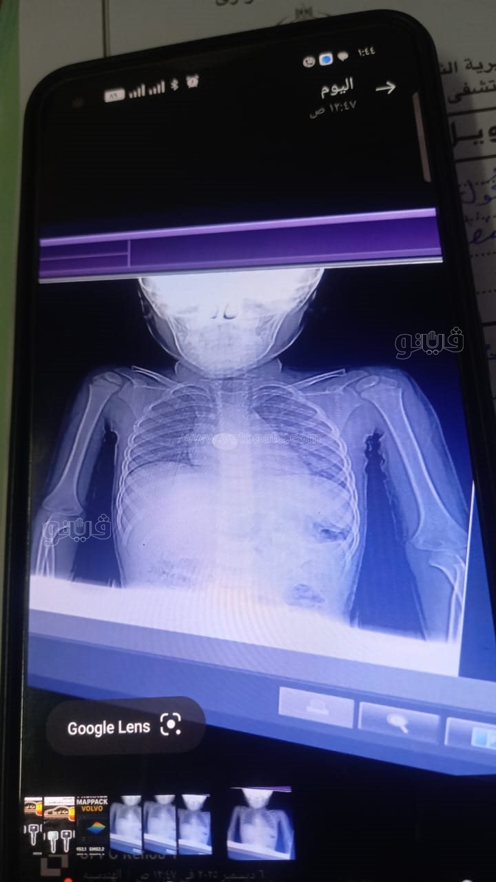 سباق مع الزمن داخل مستشفى أبو كبير.. إنقاذ طفل ابتلع بطارية قبل دقائق من الكارثة،فيتو