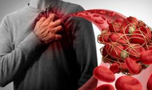 انتشار الإصابة بالجلطات، فيتو