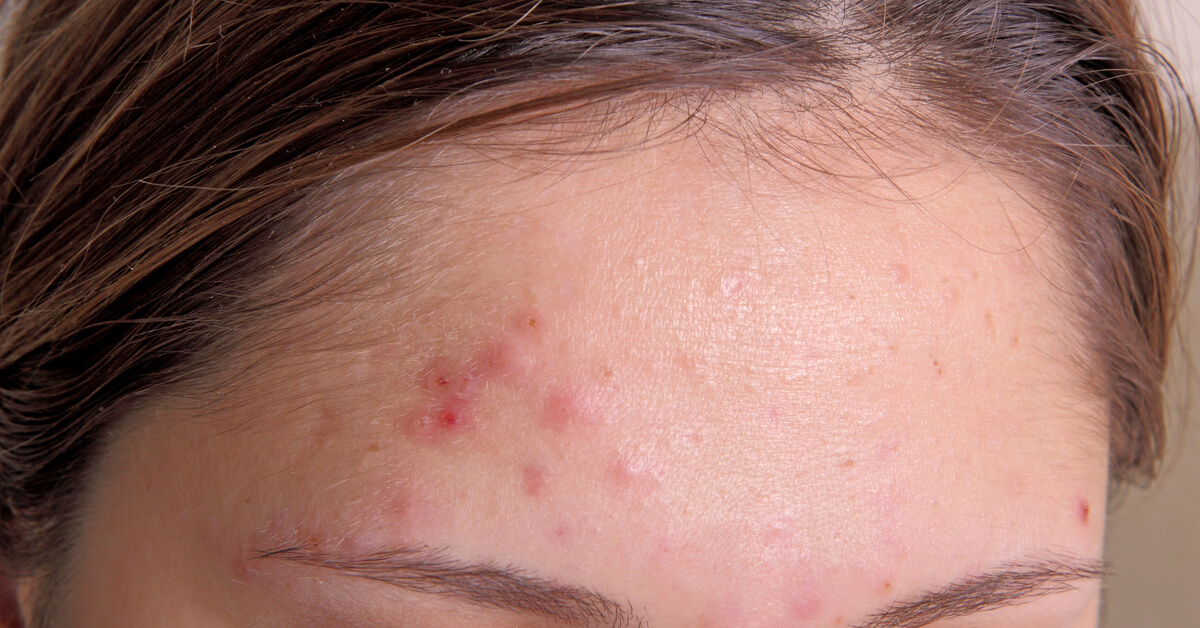 حب الشباب فى الجبهة