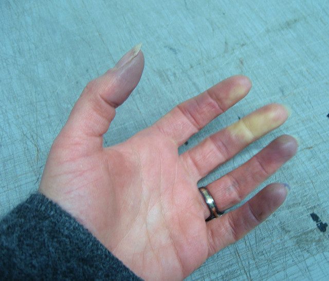 ظاهرة رينود عند النساء&nbsp;