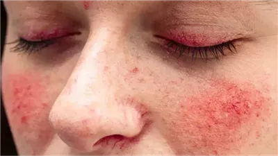 أمراض المناعة الذاتية&nbsp;