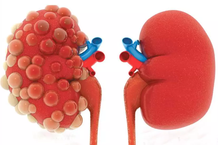 أسس التغذية السليمة لمرضى الفشل الكلوي