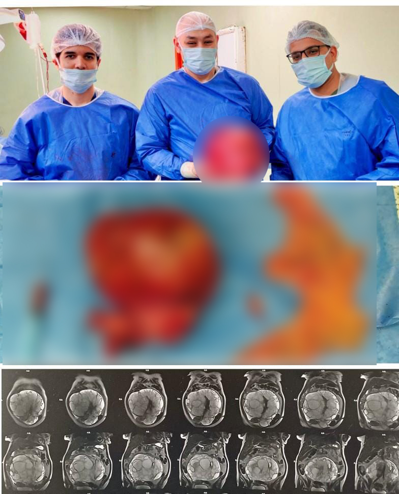 <strong>فريق طبي بمستشفى التأمين الصحي ببني سويف ينجح في استئصال ورم سرطاني ضخم</strong>